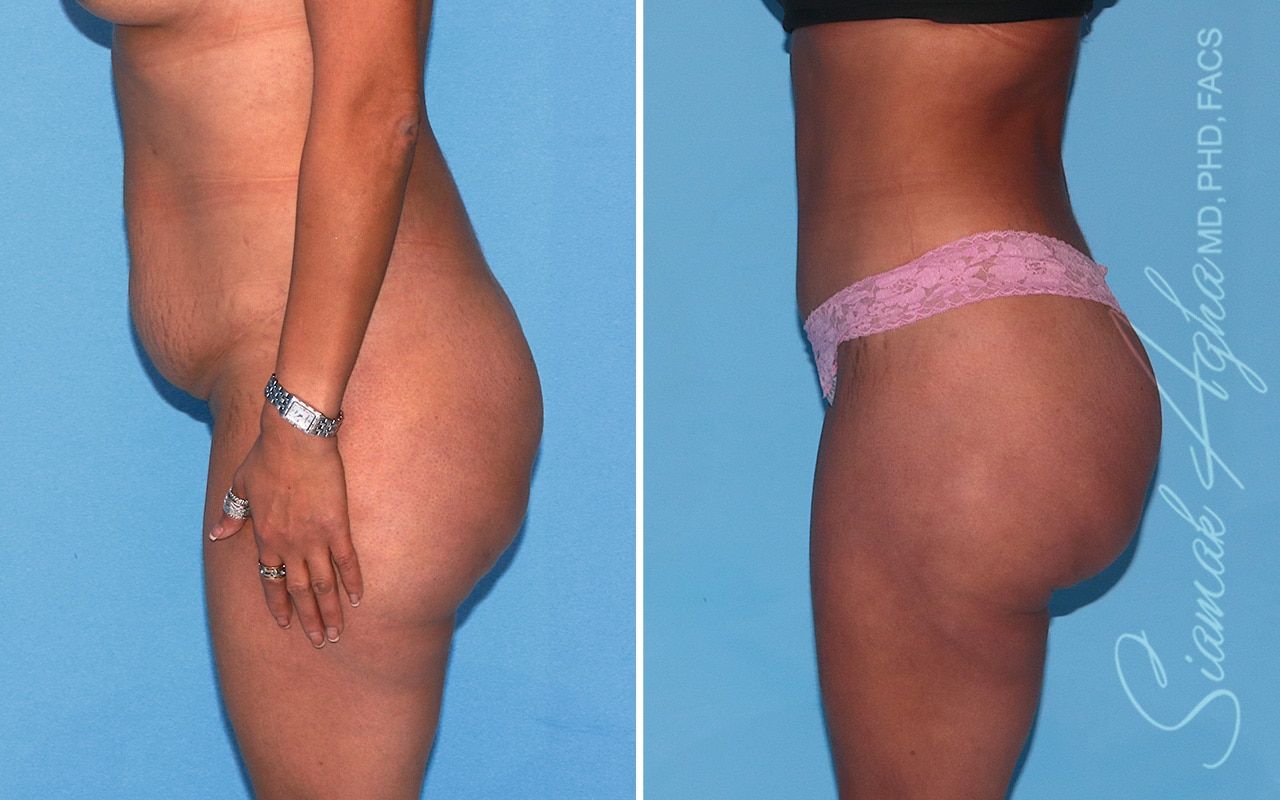 Brazilian Butt Lift Before & After