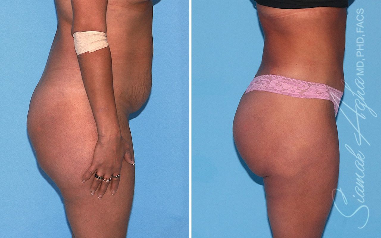 Brazilian Butt Lift Before & After