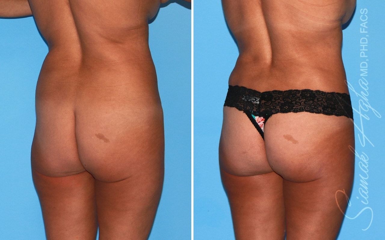 Brazilian Butt Lift Before & After