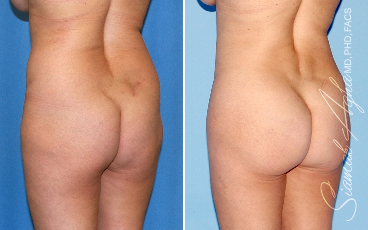 Brazilian Butt Lift Before & After
