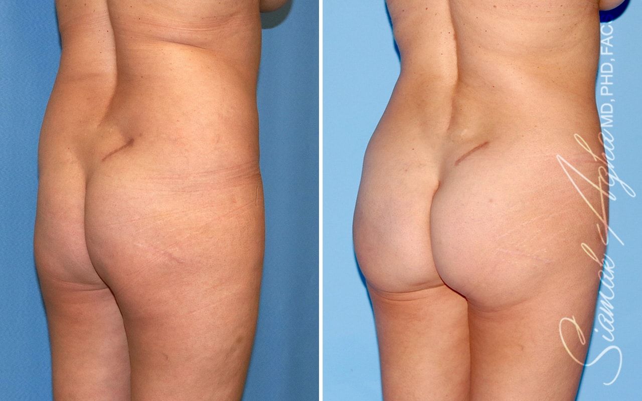 Brazilian Butt Lift Before & After
