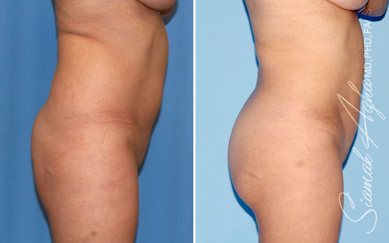 Brazilian Butt Lift Before & After