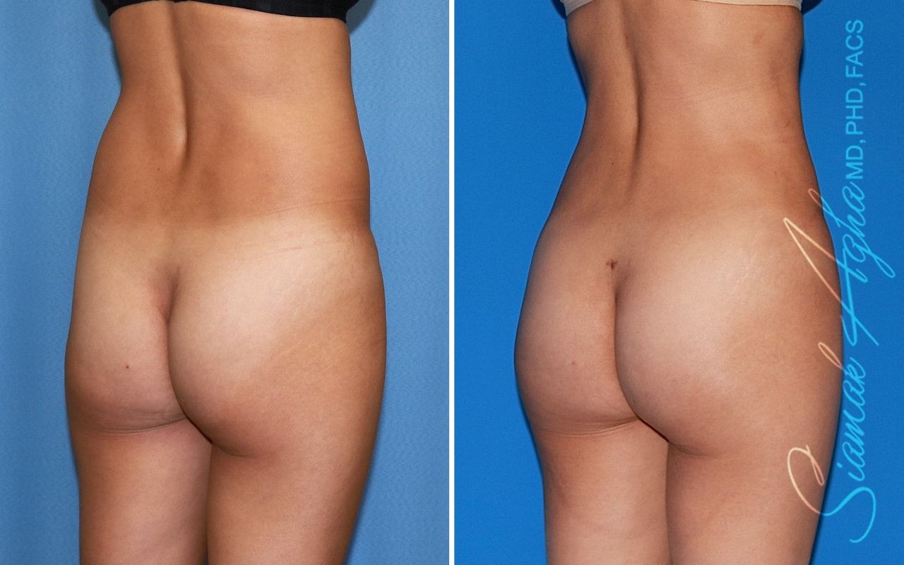 Brazilian Butt Lift Before & After