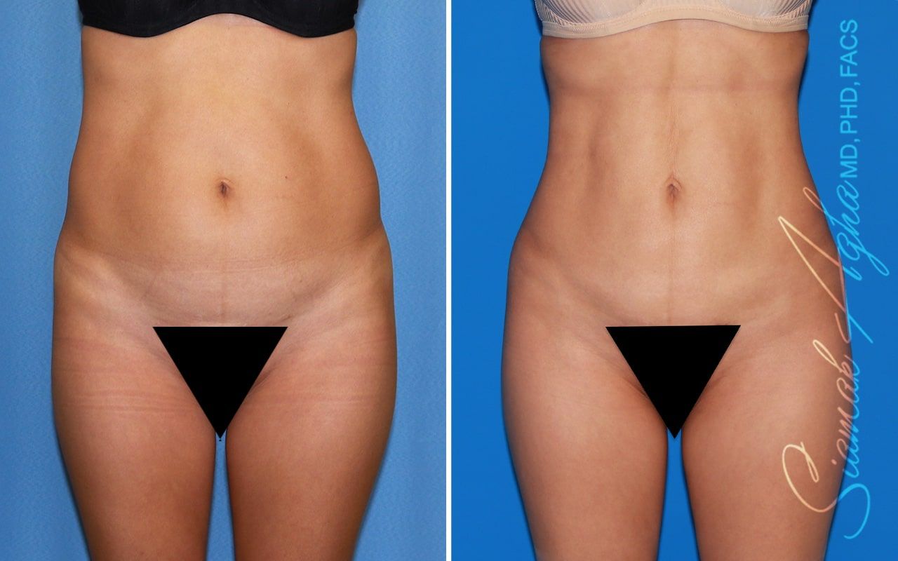 Brazilian Butt Lift Before & After