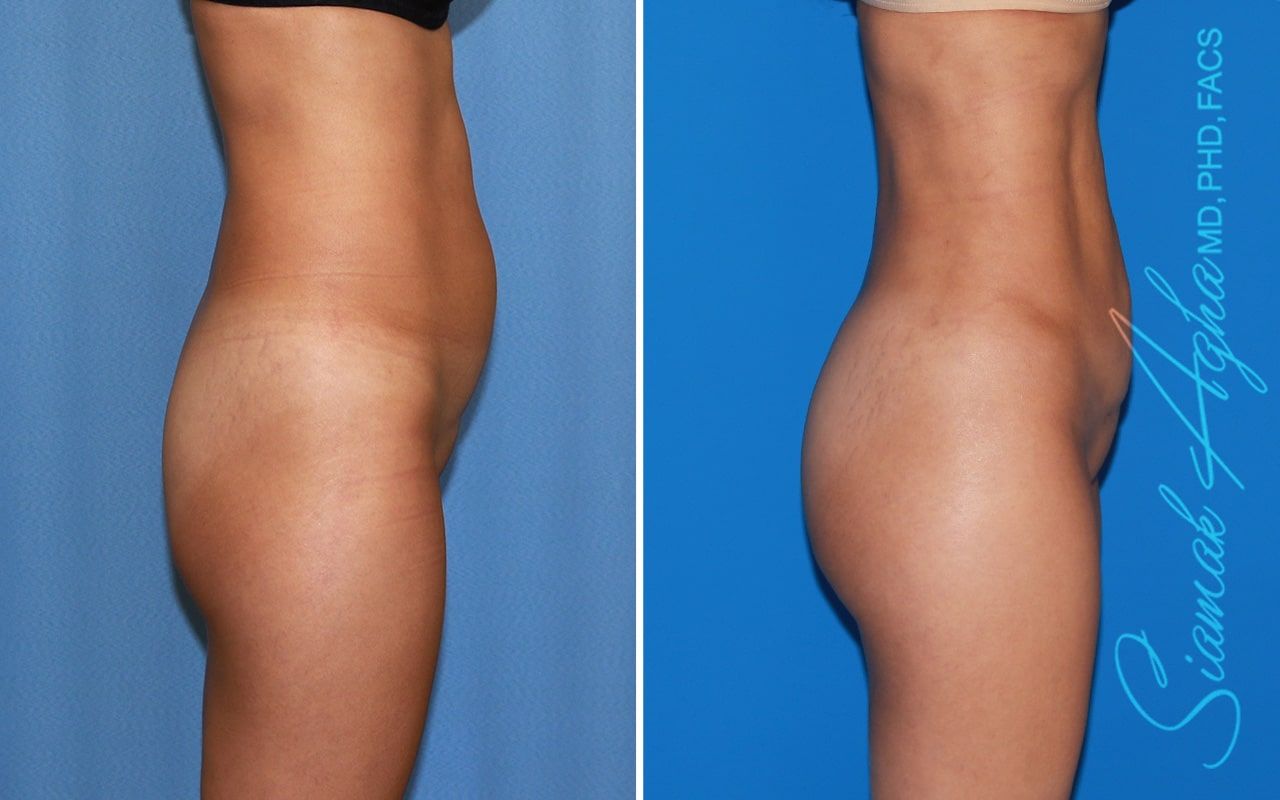 Brazilian Butt Lift Before & After