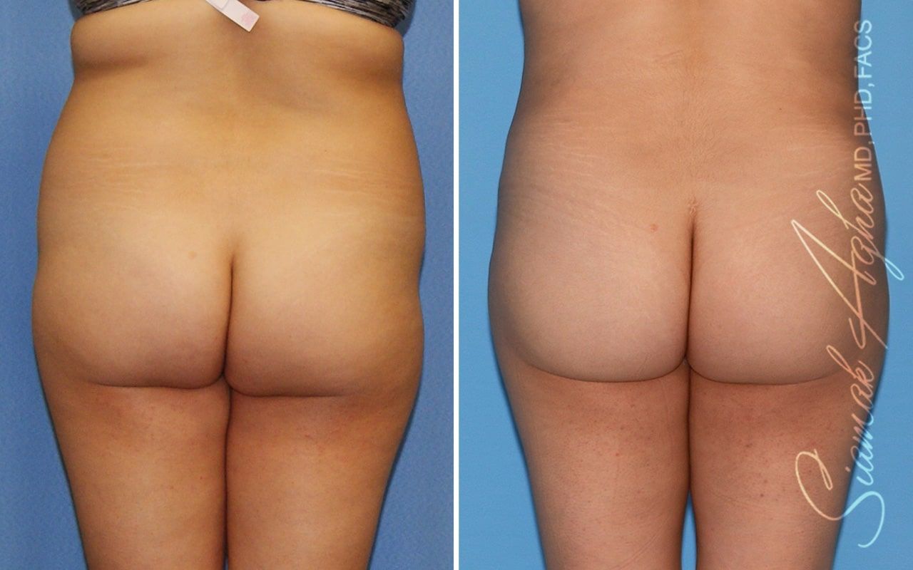 Brazilian Butt Lift Before & After
