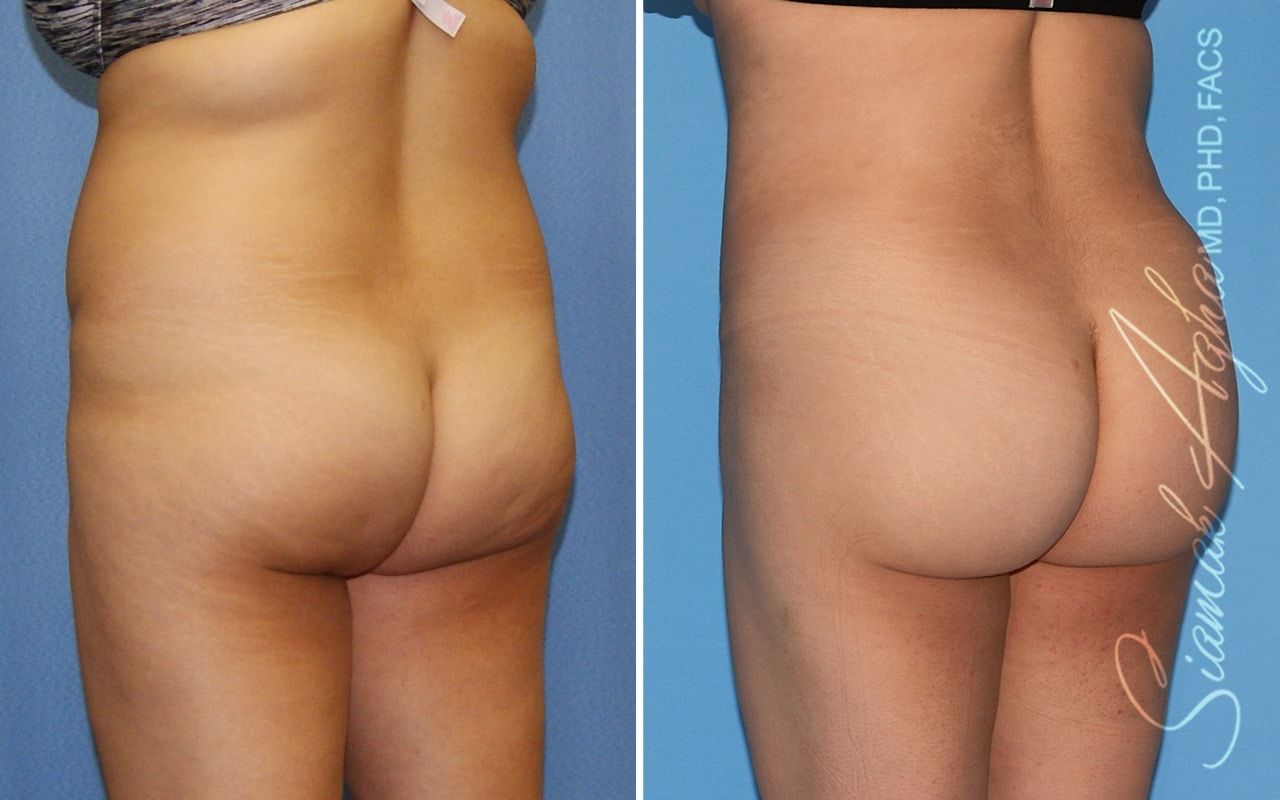 Brazilian Butt Lift Before & After