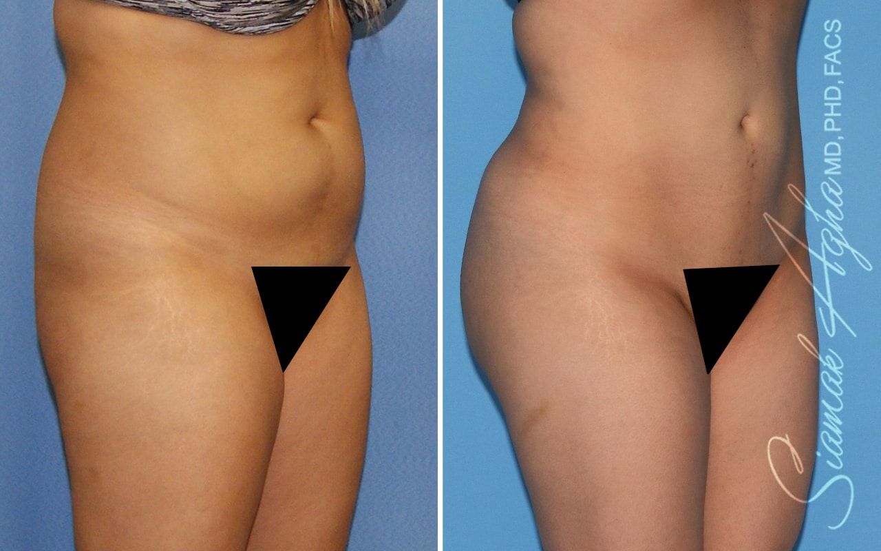 Brazilian Butt Lift Before & After