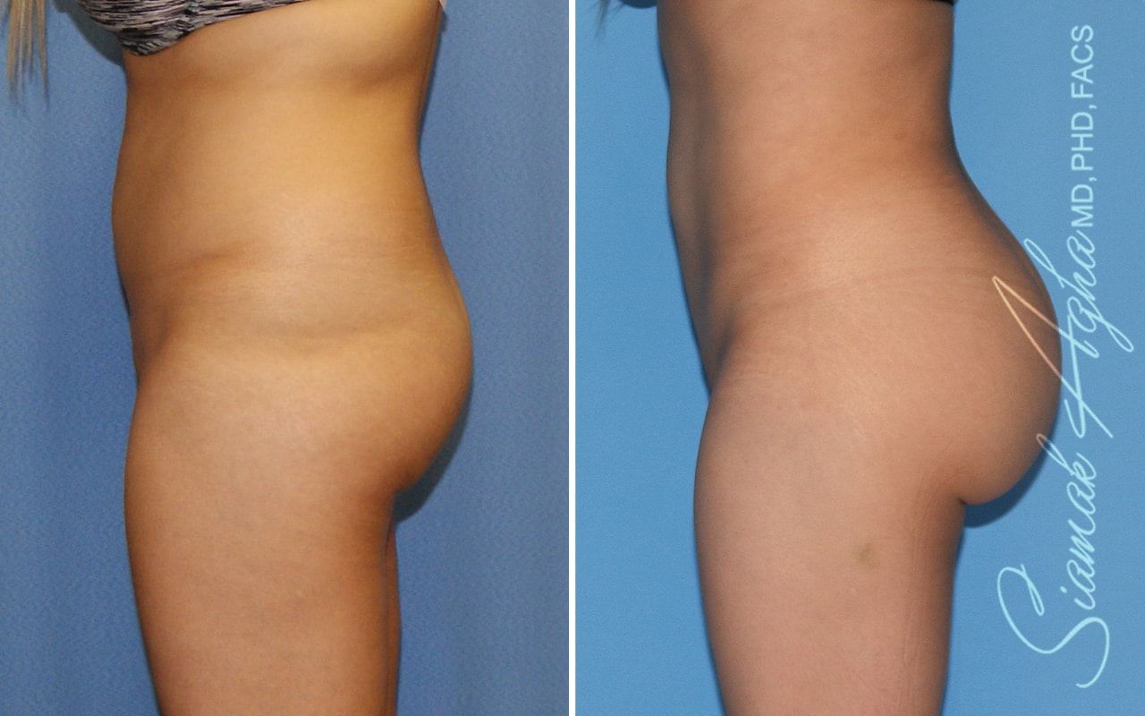 Brazilian Butt Lift Before & After