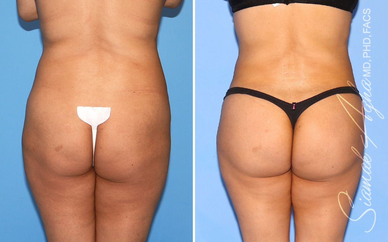 Brazilian Butt Lift Before & After