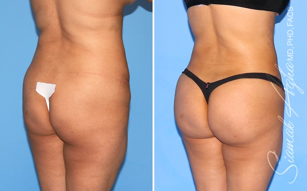 Brazilian Butt Lift Before & After