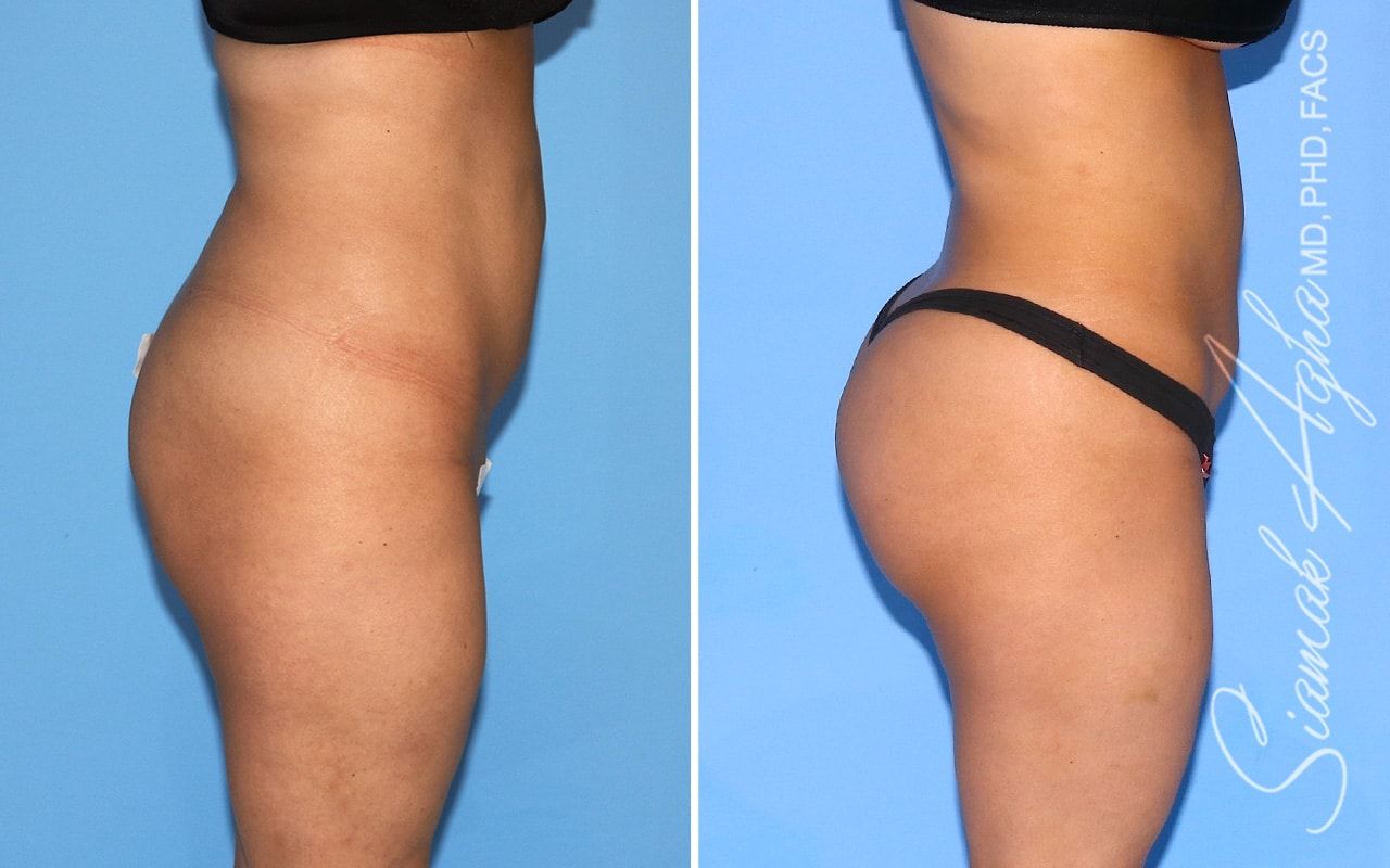 Brazilian Butt Lift Before & After