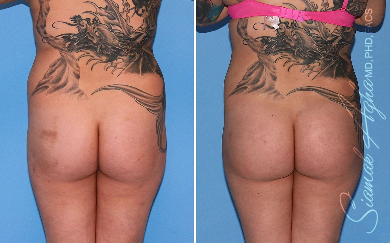 Brazilian Butt Lift Before & After