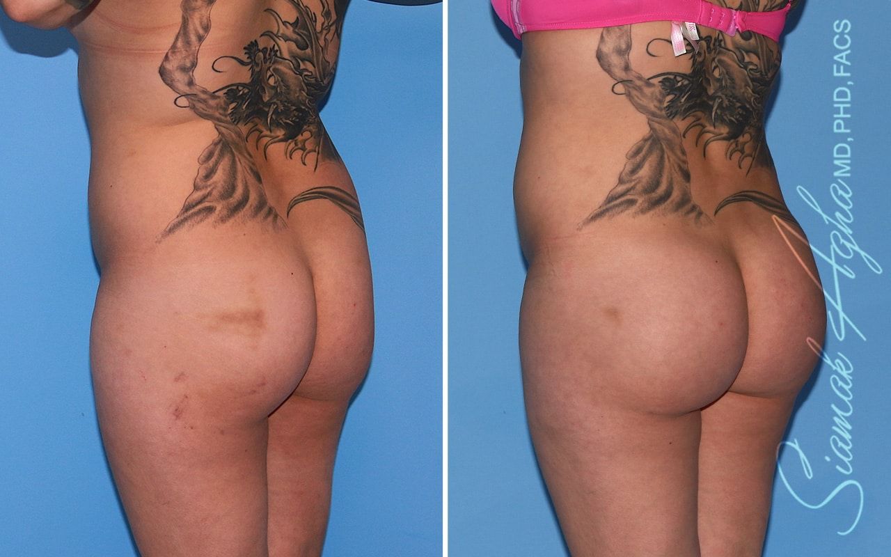 Brazilian Butt Lift Before & After