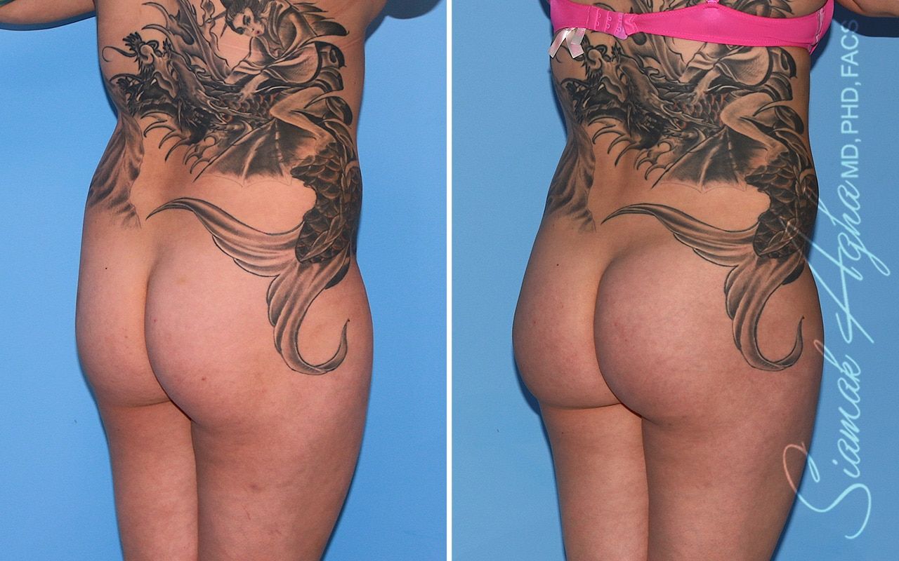 Brazilian Butt Lift Before & After
