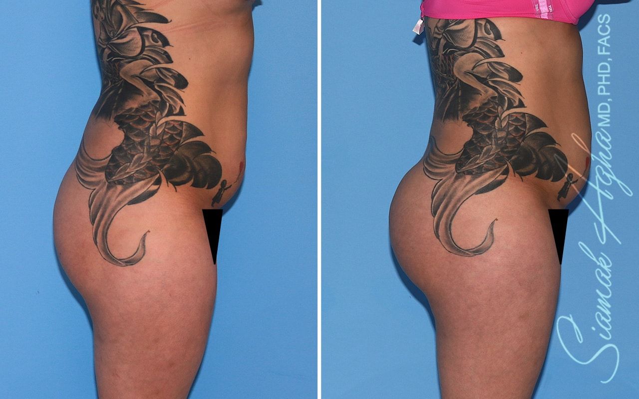 Brazilian Butt Lift Before & After