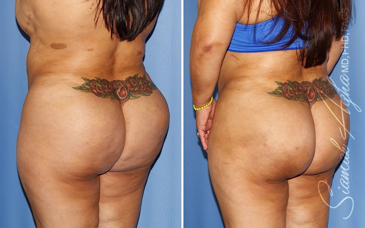 Brazilian Butt Lift Before & After