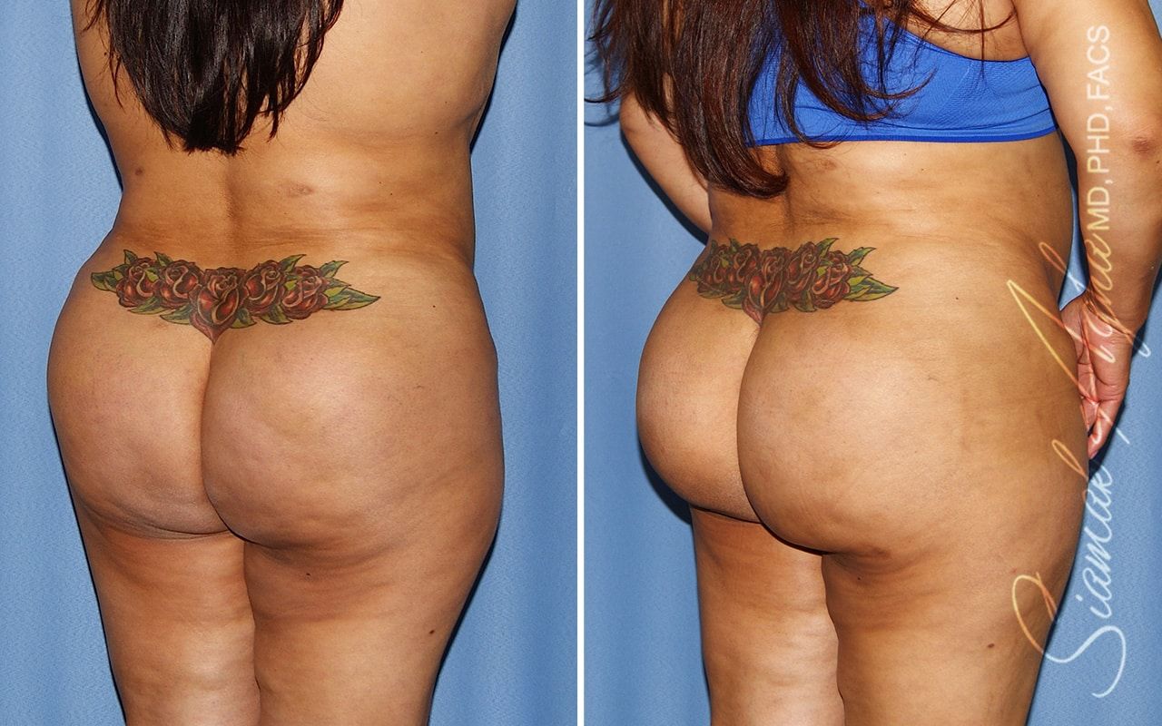 Brazilian Butt Lift Before & After