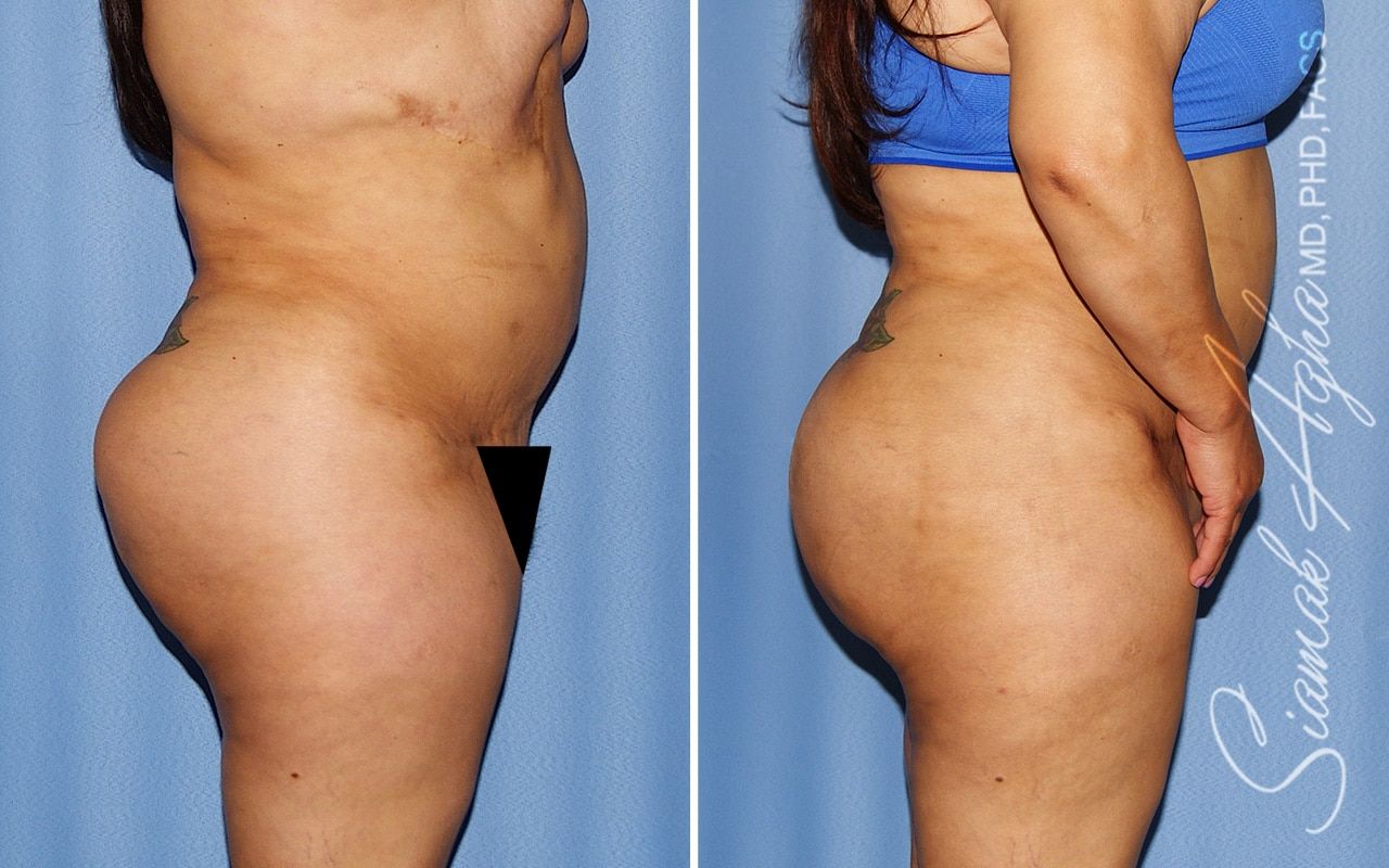 Brazilian Butt Lift Before & After