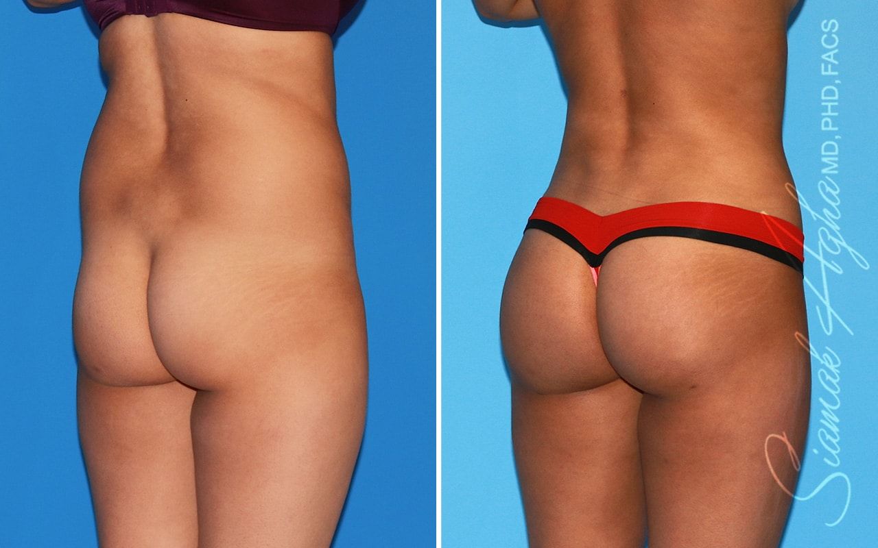 Brazilian Butt Lift Before & After