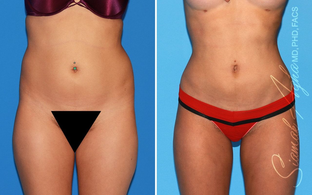 Brazilian Butt Lift Before & After