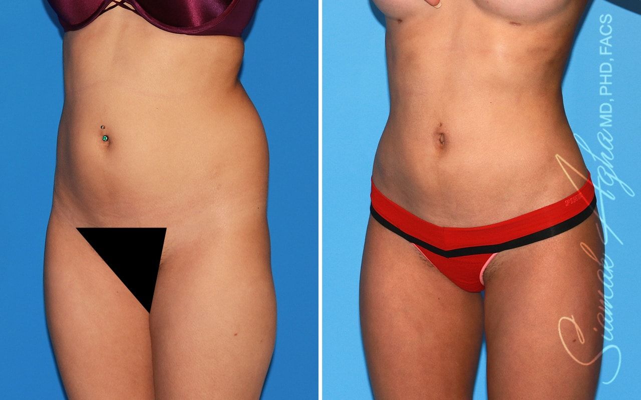 Brazilian Butt Lift Before & After