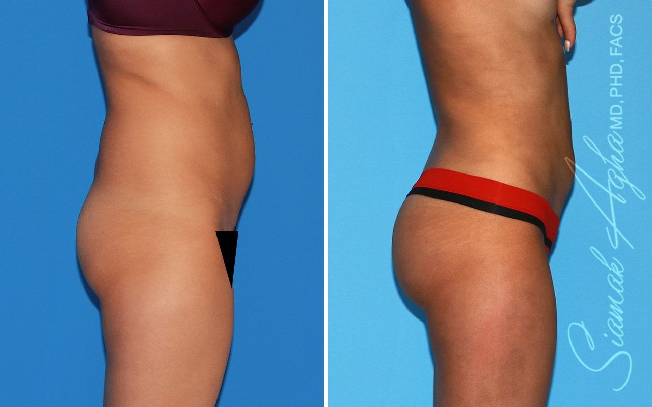 Brazilian Butt Lift Before & After
