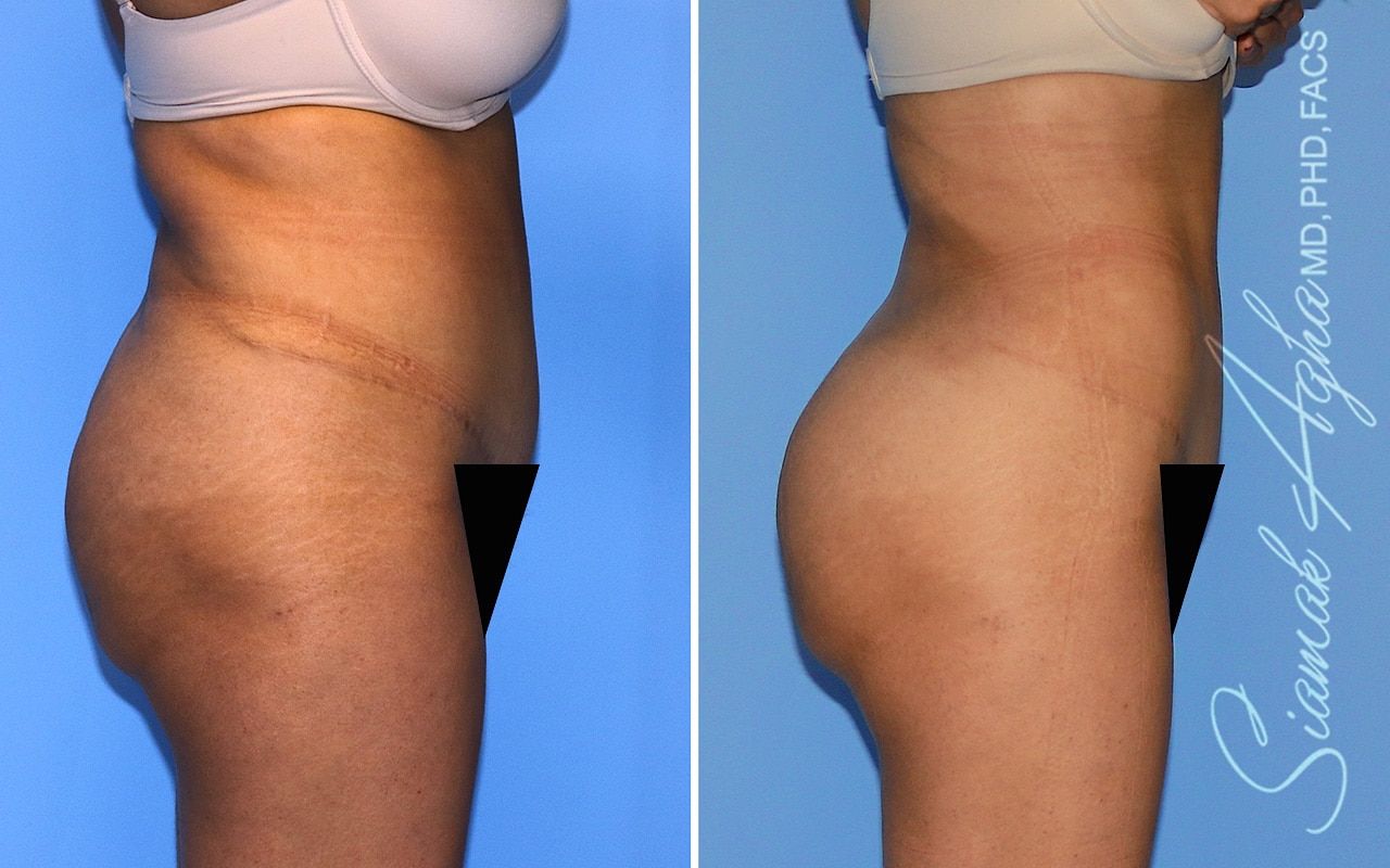 Brazilian Butt Lift Before & After