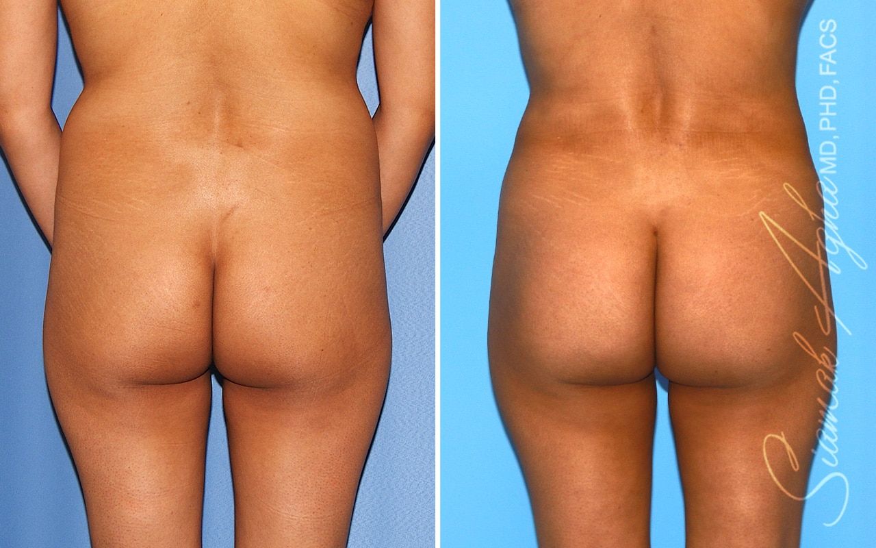 Brazilian Butt Lift Before & After