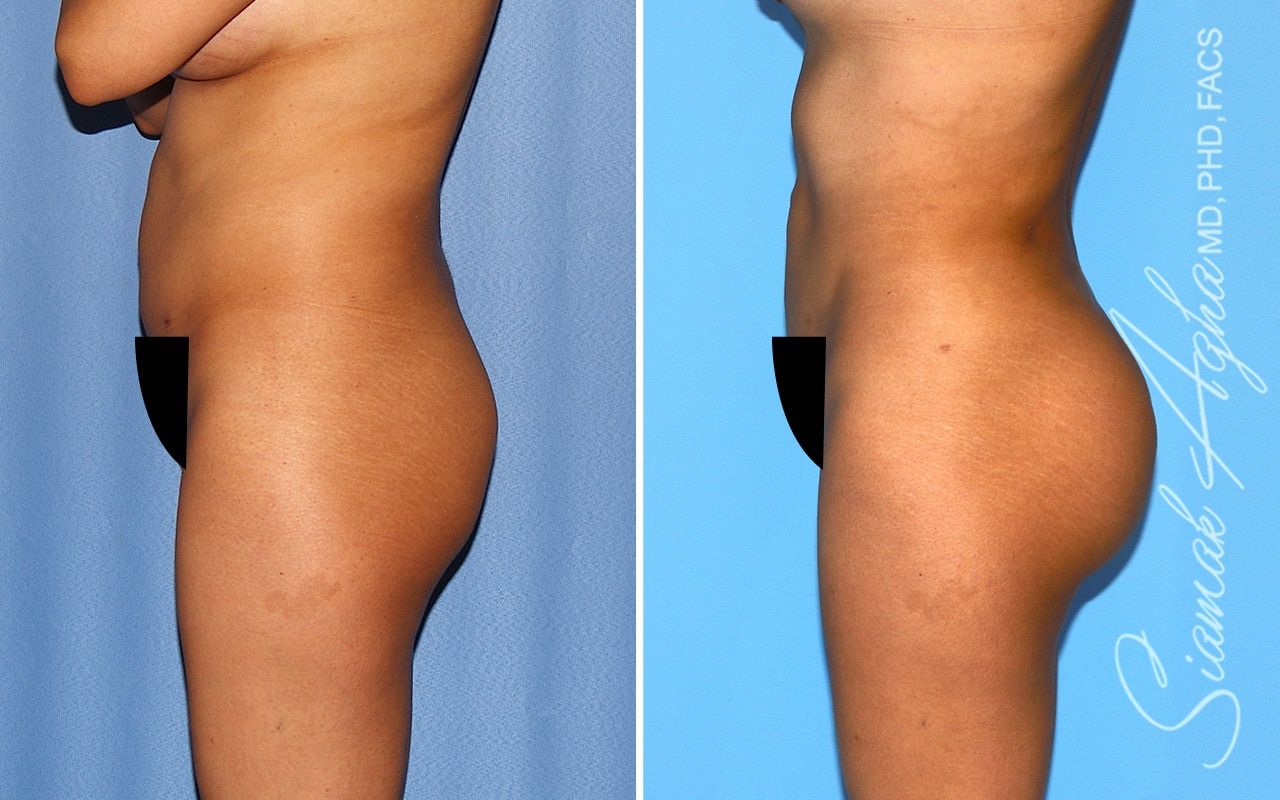 Brazilian Butt Lift Before & After