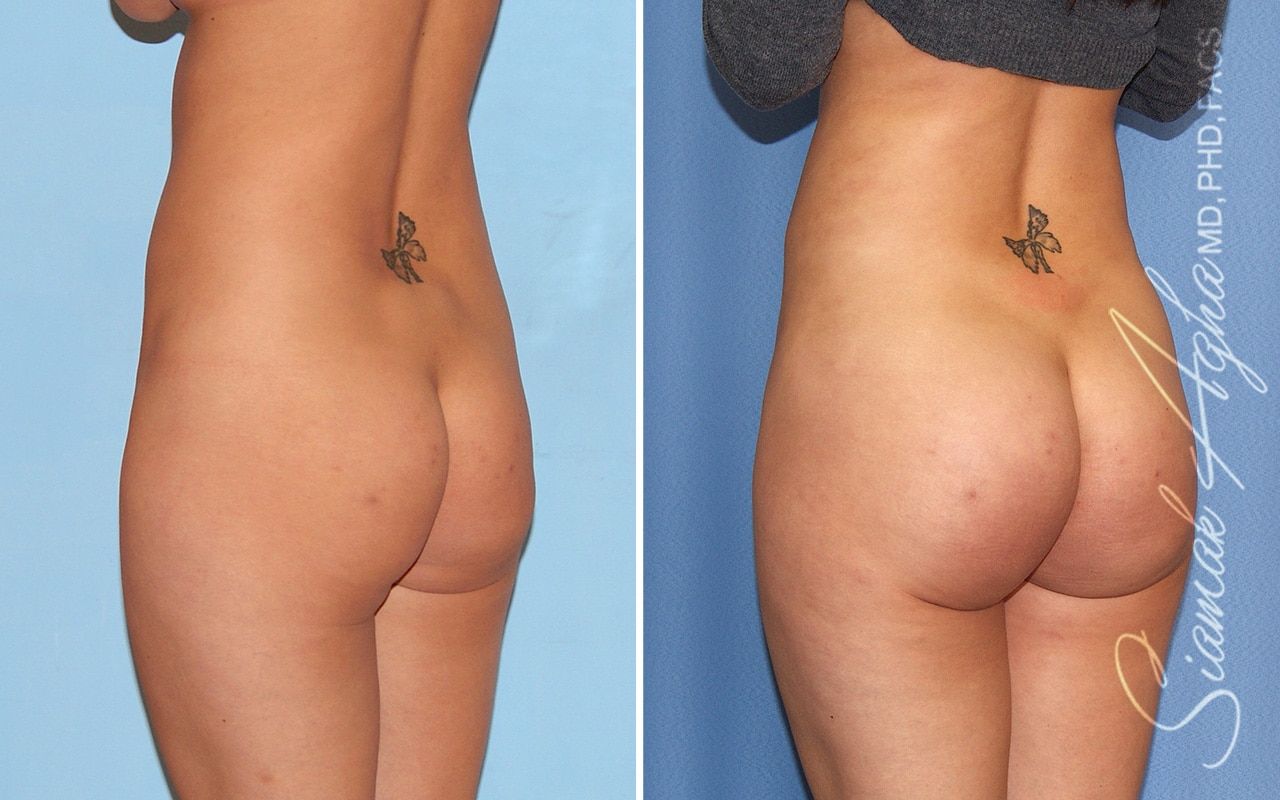 Brazilian Butt Lift Before & After