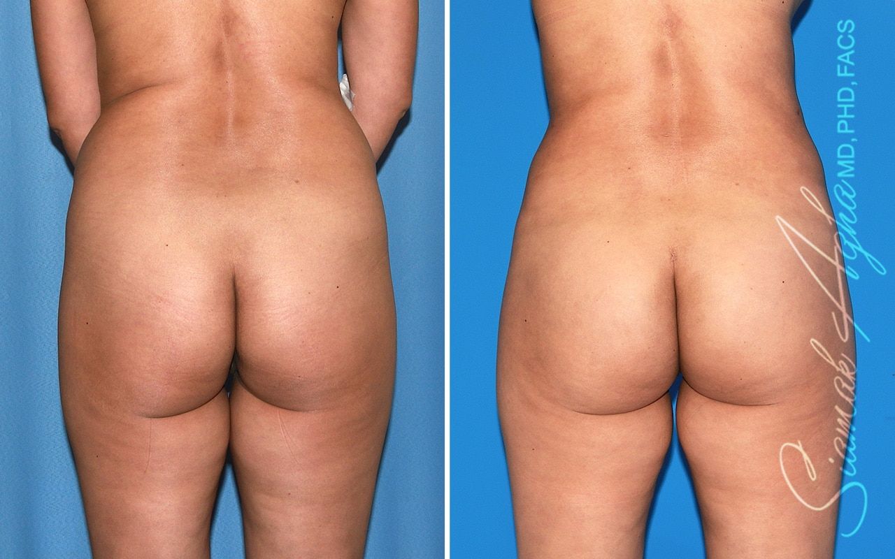 Brazilian Butt Lift Before & After