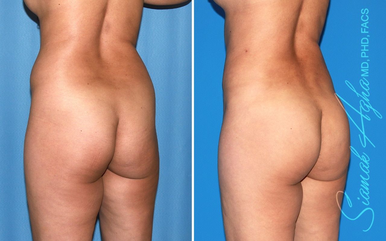 Brazilian Butt Lift Before & After
