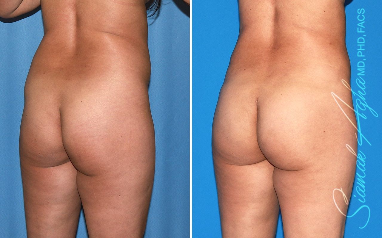 Brazilian Butt Lift Before & After