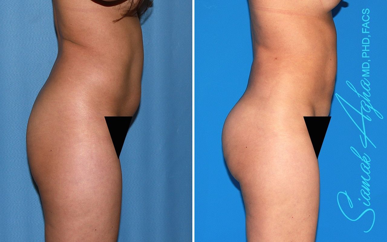 Brazilian Butt Lift Before & After
