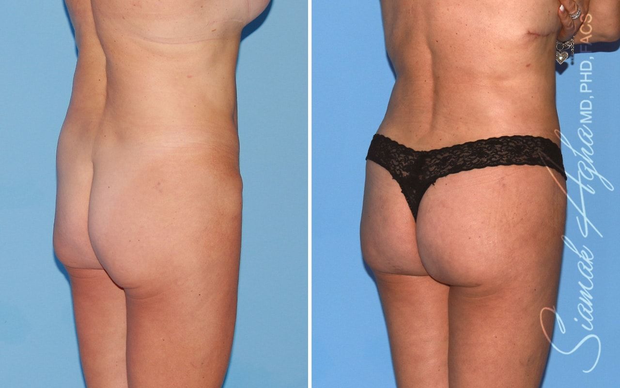 Brazilian Butt Lift Before & After