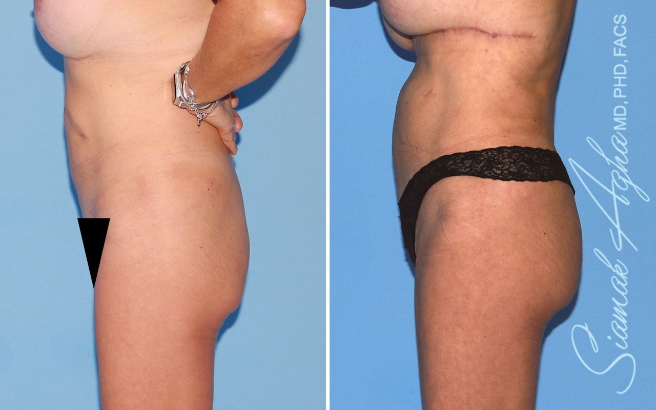 Brazilian Butt Lift Before & After