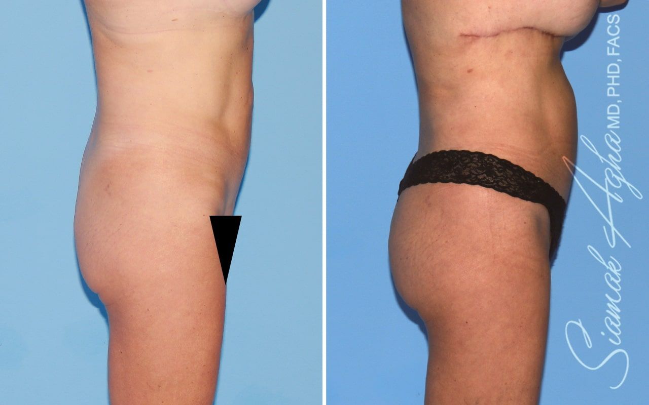 Brazilian Butt Lift Before & After