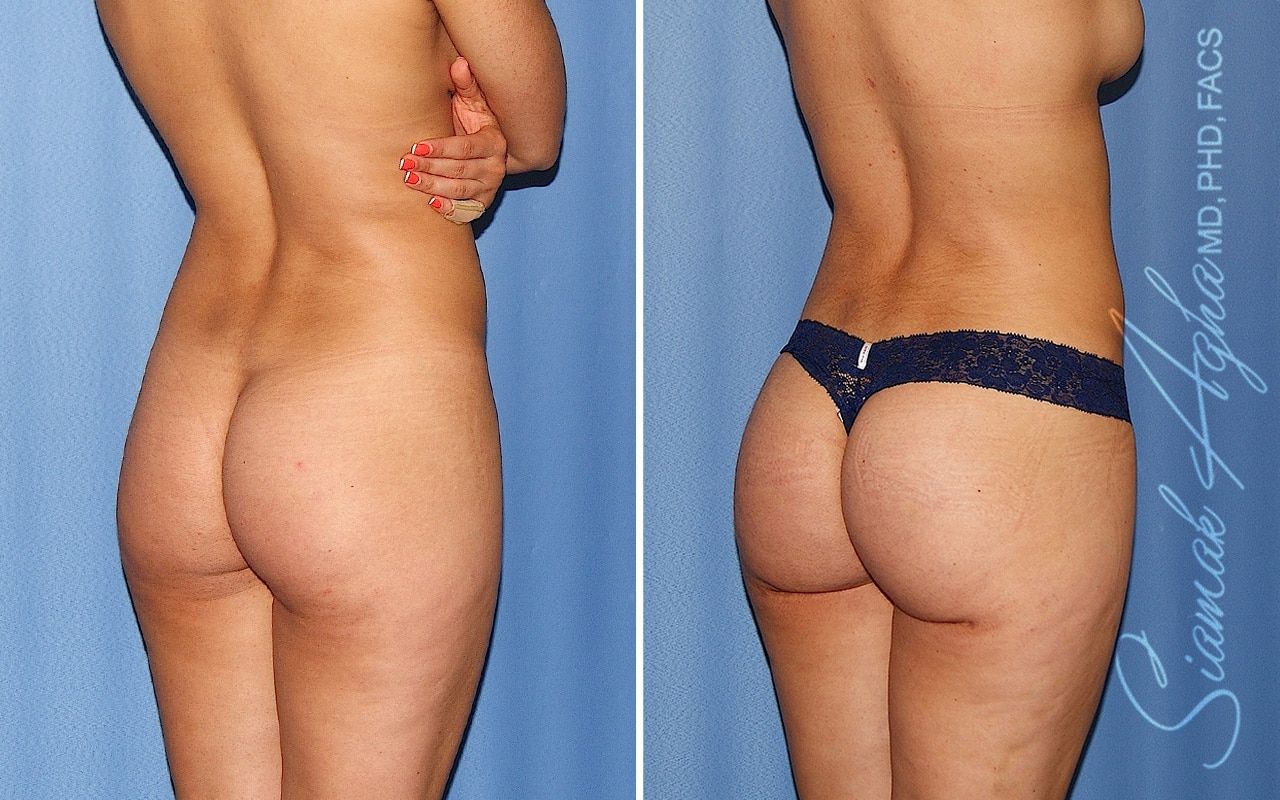 Brazilian Butt Lift Before & After