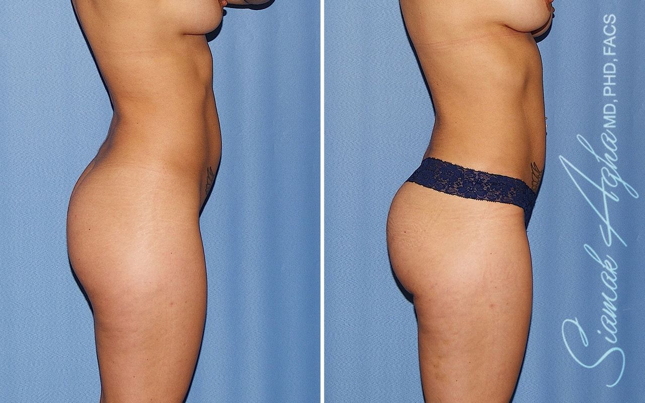 Brazilian Butt Lift Before & After