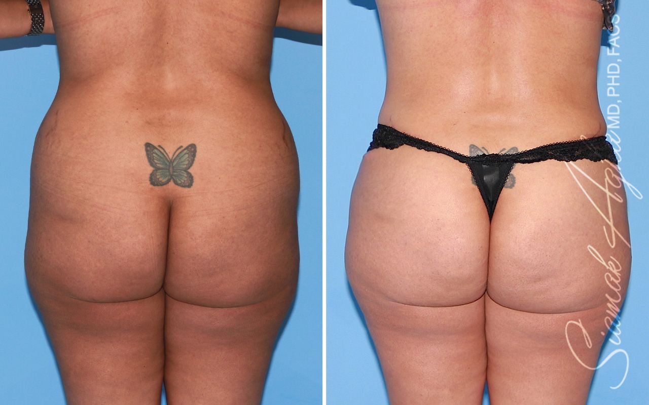 Brazilian Butt Lift Before & After