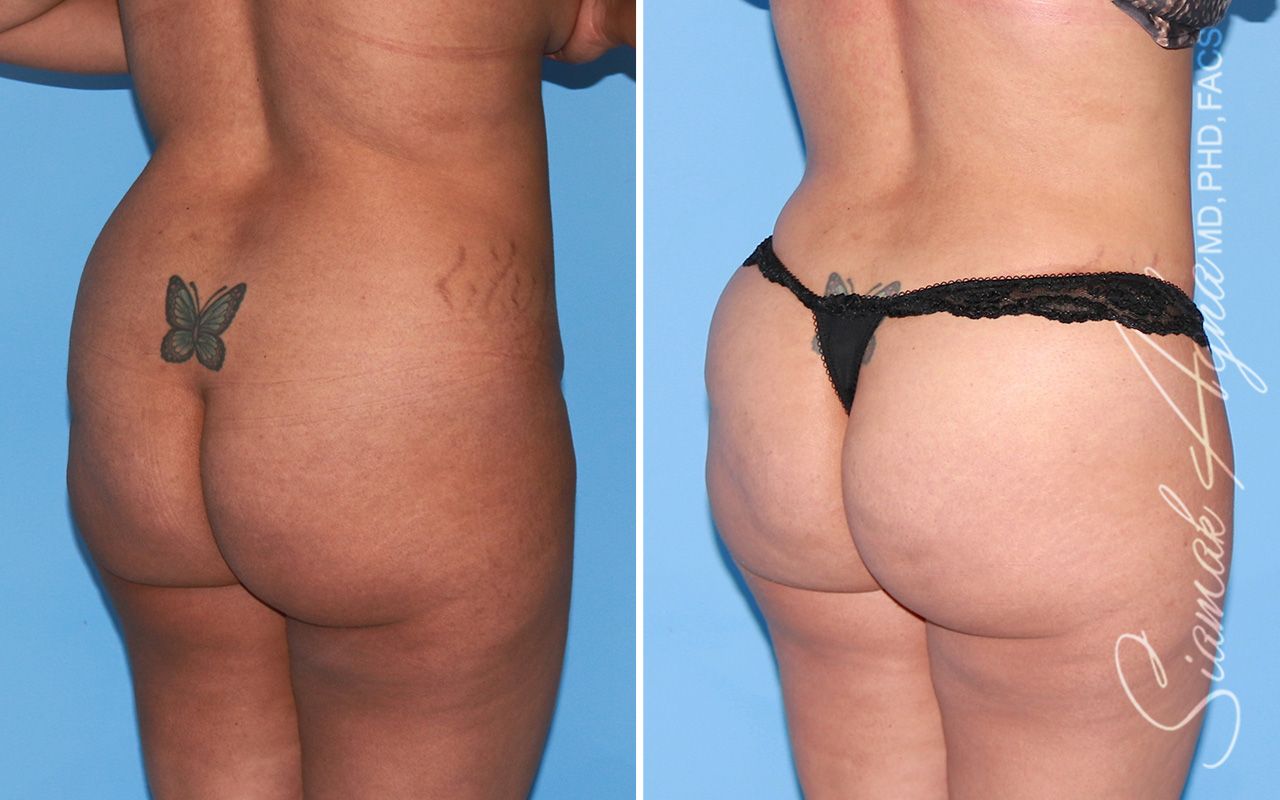 Brazilian Butt Lift Before & After