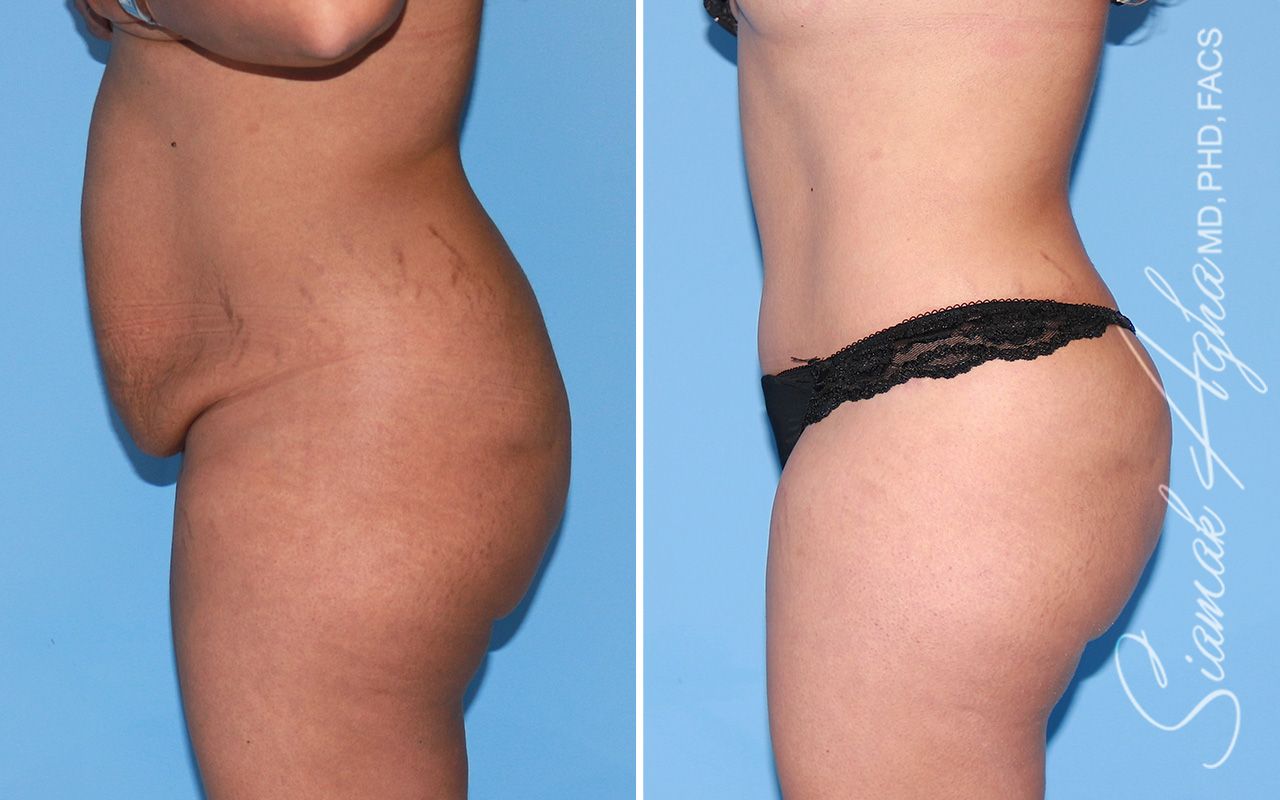 Brazilian Butt Lift Before & After