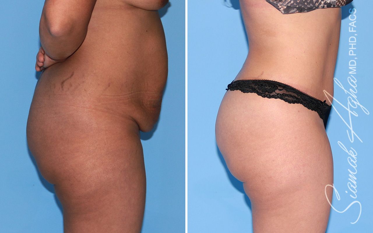 Brazilian Butt Lift Before & After