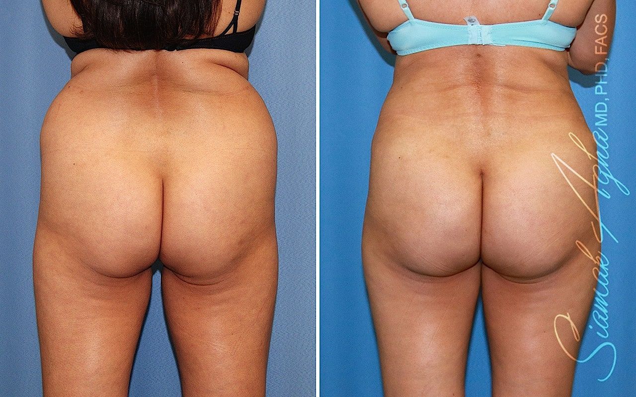 Brazilian Butt Lift Before & After