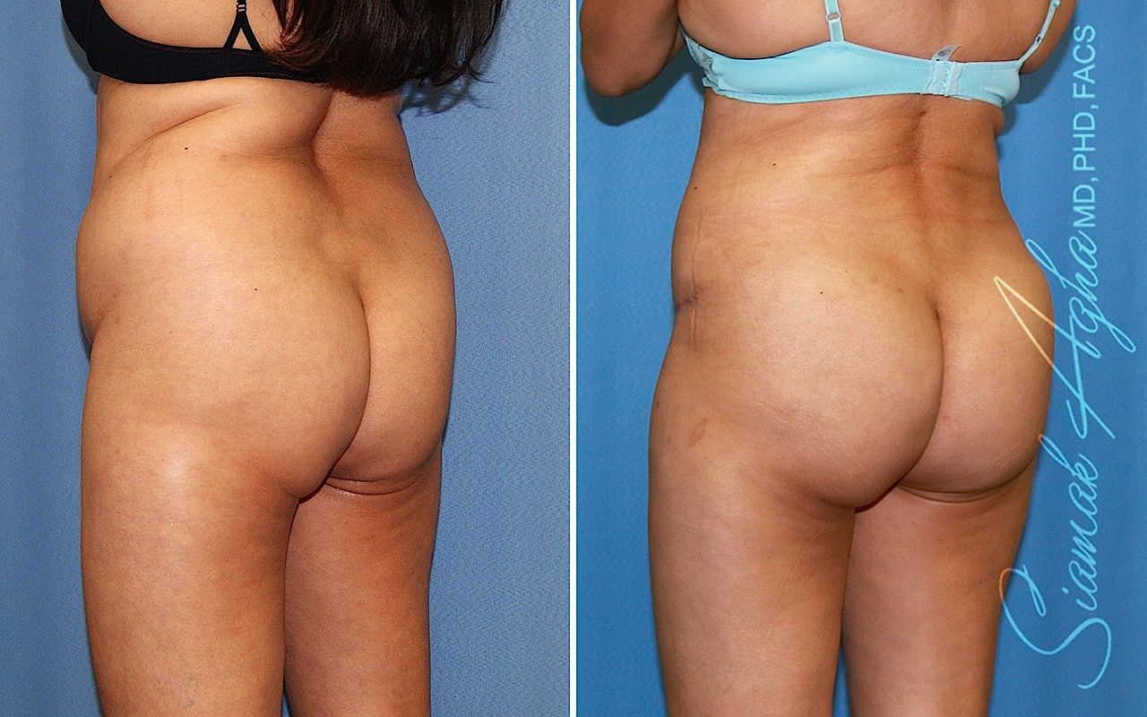 Brazilian Butt Lift Before & After