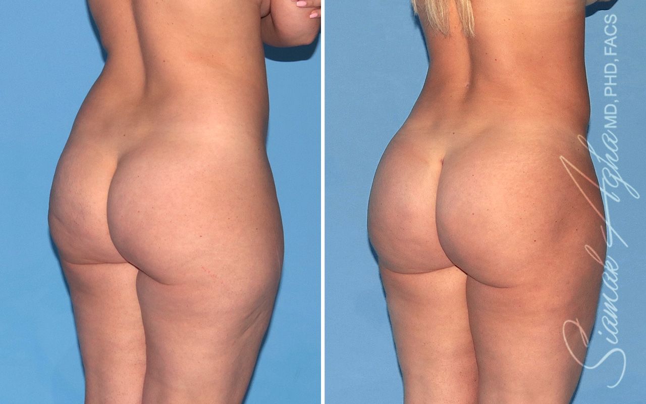 Brazilian Butt Lift Before & After