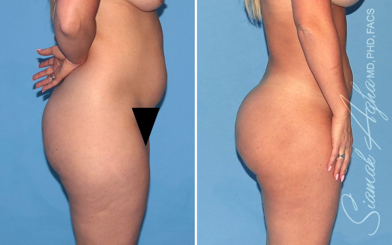 Brazilian Butt Lift Before & After