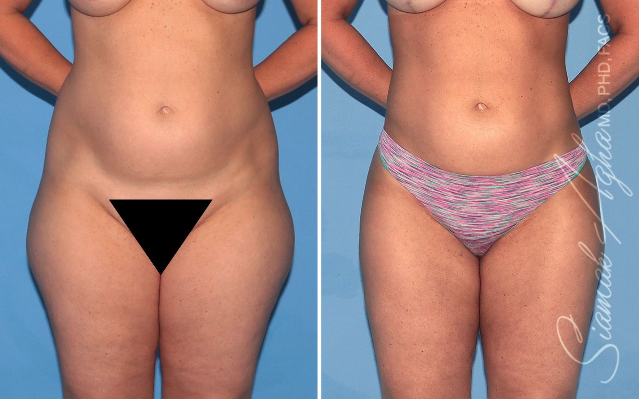 Brazilian Butt Lift Before & After