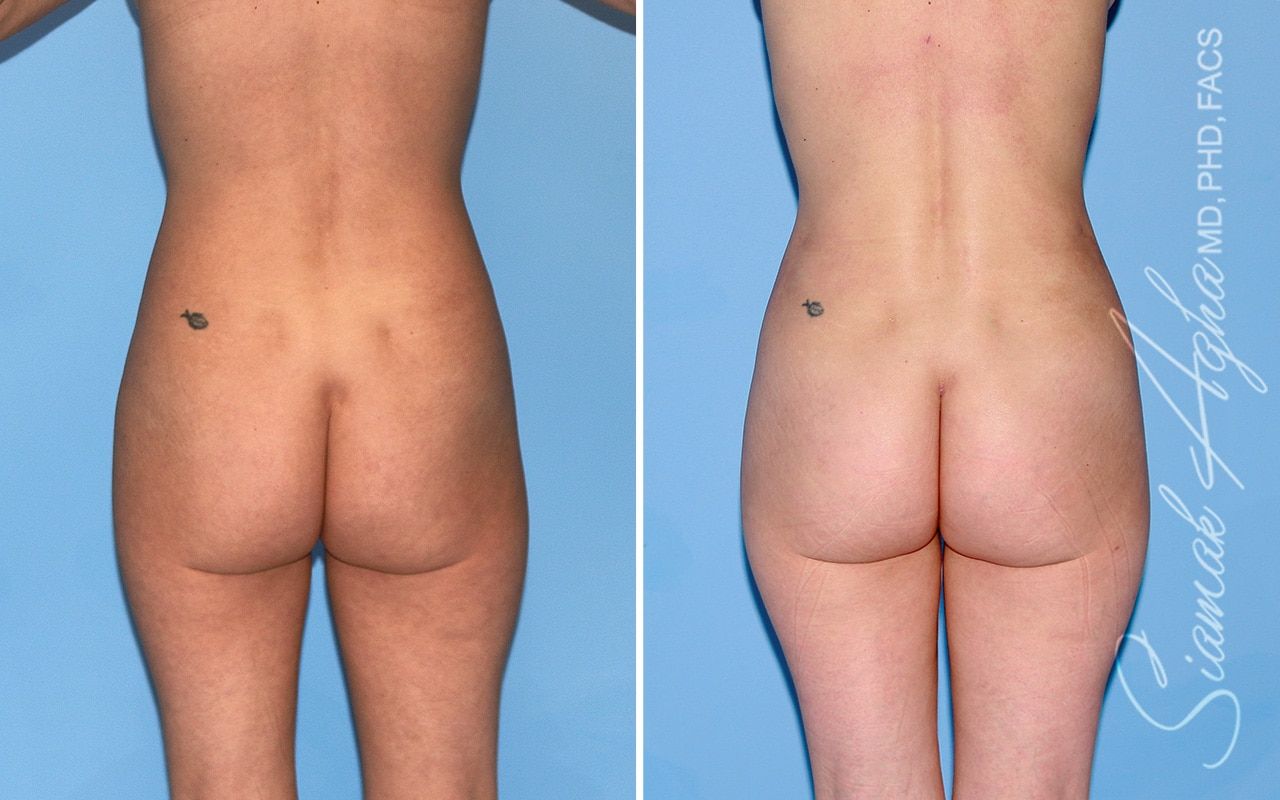 Brazilian Butt Lift Before & After